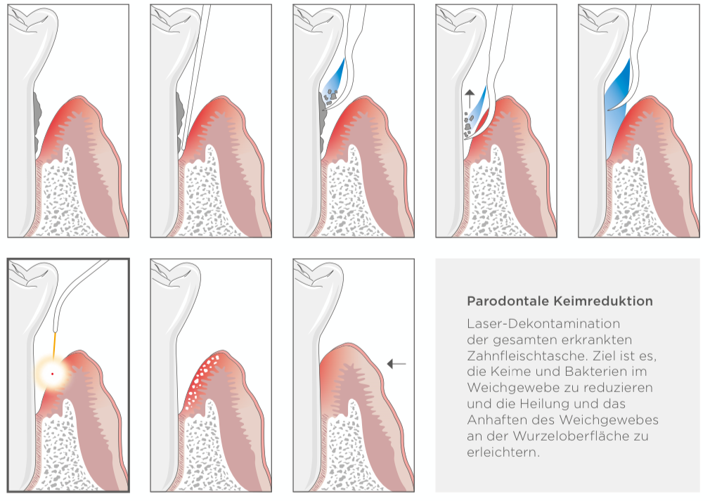 Parodontale Keimreduktion.PNG